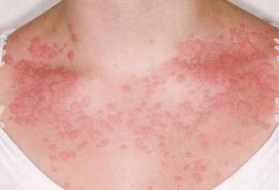 Mi urticaria, és attól, hogy emberről emberre