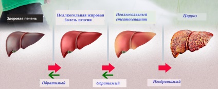 Boala de ficat gras non-alcool pentru copii (nazhbp)