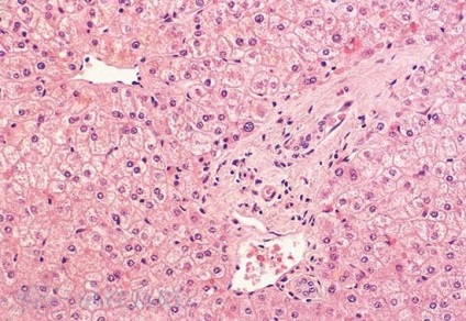 Деца неалкохолен мастен черен дроб (NAFLD)