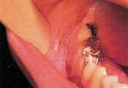 Diagnosticul bolilor mucoasei orale de-a lungul suprafeței interioare a obrajilor