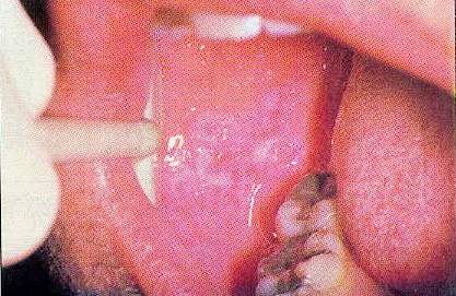 Diagnosticul bolilor mucoasei orale de-a lungul suprafeței interioare a obrajilor