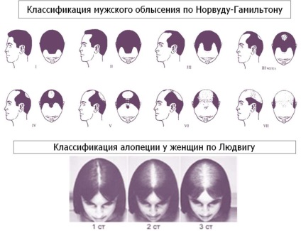 Eficacitatea transplantului de păr în alopecia androgenetică mă va ajuta