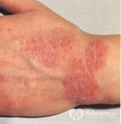 Eczemă - tratamentul și simptomele bolii