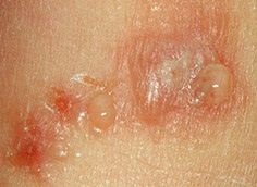 Cauza eczemelor, simptomelor, diagnosticului și tratamentului
