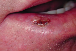 Fotografie a cancerului de buze - primele semne (simptome), cum arata