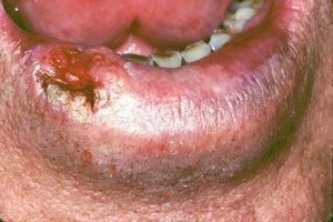Fotografie a cancerului de buze - primele semne (simptome), cum arata