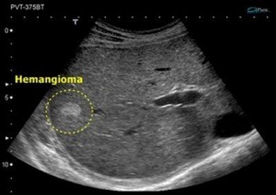 Haemangioma a májban - ez a kezelés haemangiomáknak