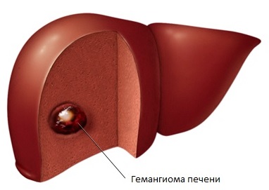 Hemangiomul hepatic - care este tratamentul cu hemangiom