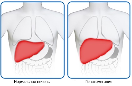 Simptome și complicații hepatomegale, cum se tratează extinderea ficatului