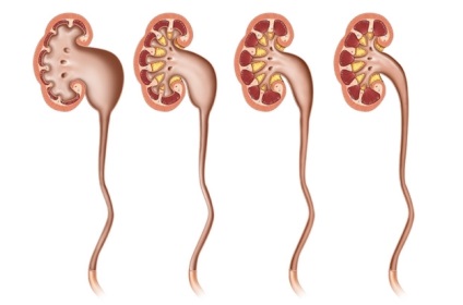 Hydronephrosis vese - mi ez, egy hydronephrosishoz A bal vese, hydronephrosis a jobb vese