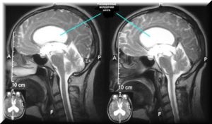 Hidrocefalia creierului la nou-născuți - diagnostic, tratament, simptome