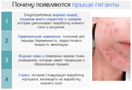 Giant acnee sub piele și pe spate - motive și soluții