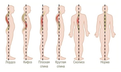Hiperpozitia coloanei vertebrale toracice