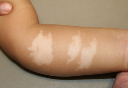Hipomelanoza de ce sunt pete albe pe piele