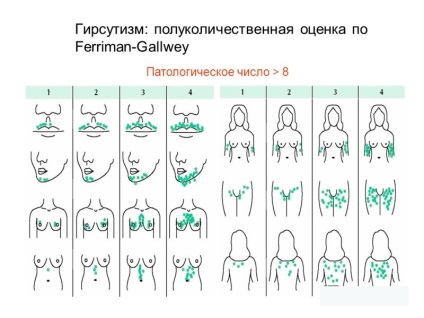 Hirsutism cauzele, simptome și tratament