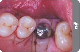 Имплантирането със симултанен синус лифт - имплантология - новини и статии за стоматология -