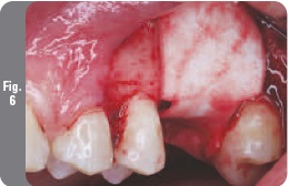 Az implantáció egyidejű sinus lift - Implantológia - hírek és cikkek a fogászatban - (sinus lift) Az implantáció egyidejű sinus lift - Implantológia - hírek és cikkek a fogászatban -