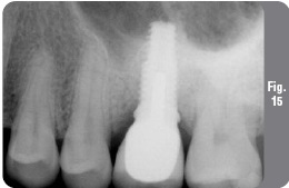 Implantare cu lifting simultan - implantologie - știri și articole despre stomatologie -