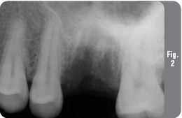 Implantare cu lifting simultan - implantologie - știri și articole despre stomatologie -