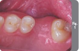 Az implantáció egyidejű sinus lift - Implantológia - hírek és cikkek a fogászatban - (sinus lift) Az implantáció egyidejű sinus lift - Implantológia - hírek és cikkek a fogászatban -