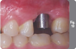 Имплантирането със симултанен синус лифт - имплантология - новини и статии за стоматология -