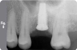 Implantare cu lifting simultan - implantologie - știri și articole despre stomatologie -