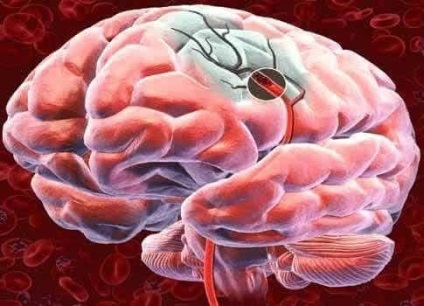 Ce vitamine sunt necesare pentru sănătate după un accident vascular cerebral