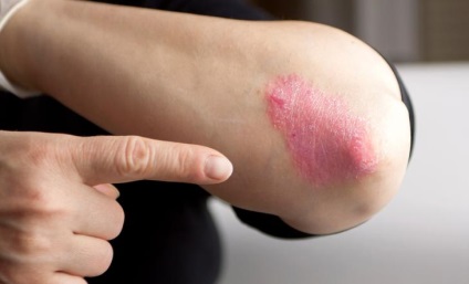 Cum să evitați exacerbarea regulilor eczemei ​​7