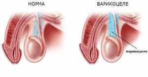 Cum să tratați varicocele fără intervenție chirurgicală - metode populare de tratare a bolii