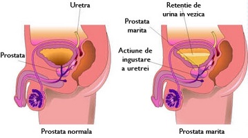 Cum să luați Nitroxoline cu prostatită