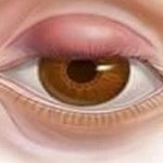 Hogyan lehet eltávolítani allergiás ödéma szemét