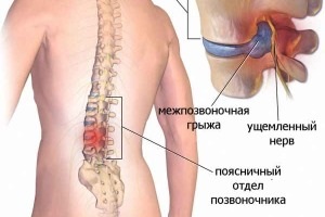 Cum am învins măduva spinării! Ești sănătos!