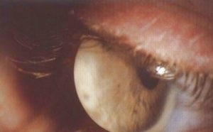 Keratoglobus és fő jellemzői, lehetőség gyógyító és megelőző intézkedések (Keratoglobus) Keratoglobus és fő jellemzői, lehetőség gyógyító és megelőző intézkedések