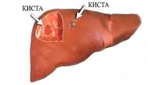 Chistul ficatului - cauzele, simptomele, diagnosticul și tratamentul, care sunt chisturile hepatice