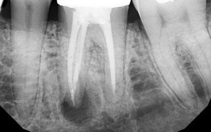 Osztályozása a fogágy, periodontiíissei típusok (fotók és videó)