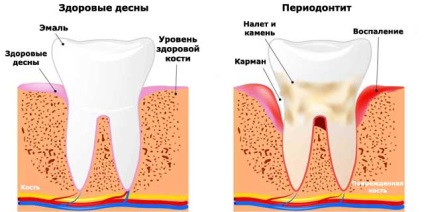 Clasificarea parodontitei, tipuri de parodontita (fotografii și clipuri video)