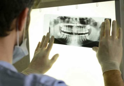 Clasificarea parodontitei, tipuri de parodontita (fotografii și clipuri video)