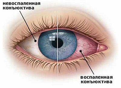 Вирусен конюнктивит как да се лекува бързо при възрастни