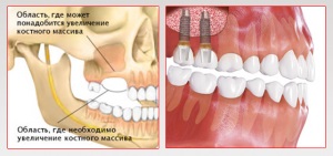 Csontpótlás csontpótlás implantáció