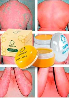 Crema de psoriazis pe spate, creme de psoriazis (cremă pentru psoriazisul spatelui) Crema pentru psoriazis pe spate, creme din psoriazis