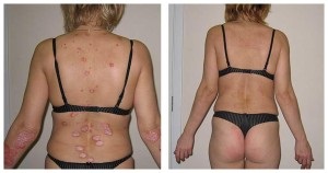 Crema de la psoriazis pe spate, creme de psoriazis (cremă de psoriazis pe spate) Crema pentru psoriazis pe spate, creme din psoriazis