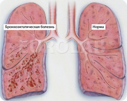 Tratamentul bronhiectazei - portal medical eurolab