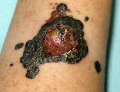 Tratamentul metodelor de melanom, avantaje și dezavantaje, efecte, predicții, video