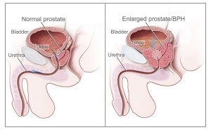 Tratamentul prostatitei cu ierburi, plante medicinale