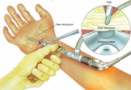Anatomia articulației încheieturilor, mrt și uzi în tratamentul durerii cauzate de stiloidită și alte leziuni
