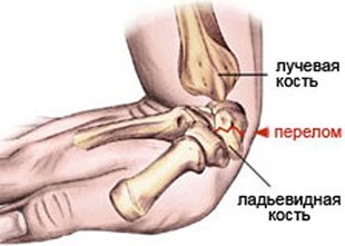 Anatomia articulației încheieturilor, mrt și uzi în tratamentul durerii cauzate de stiloidită și alte leziuni