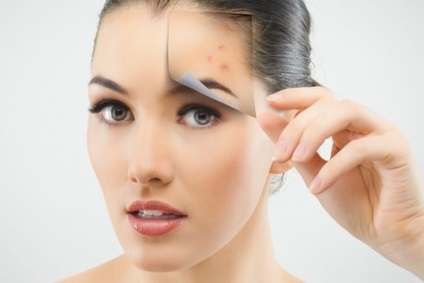 Metronidazol de la recenzii de acnee