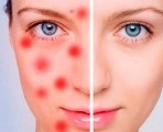 Metronidazol de la recenzii de acnee