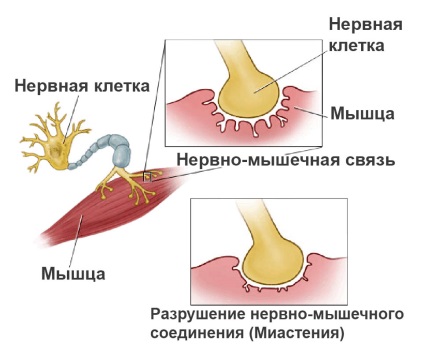 Myasthenia gravis cauze, simptome, diagnostic, prevenire și tratament