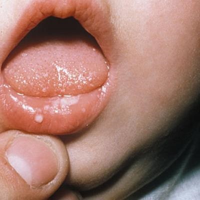 Stomatita (drojdie stomatită) la un copil - simptome și tratament cu remedii folclorice în gospodărie